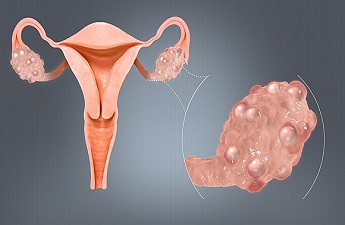 Know All about Ovarian Cysts and Gynaecologist and Obstetrician Dr. Ila Tyagi