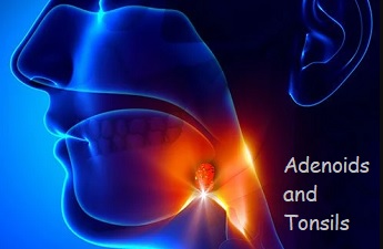 Adenoid and tonsil