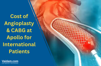 Costul angioplastiei și CABG la Apollo pentru pacienții internaționali Costul angioplastiei și CABG la Apollo pentru pacienții internaționali