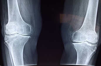 Qualité de vie après une chirurgie de remplacement du genou
