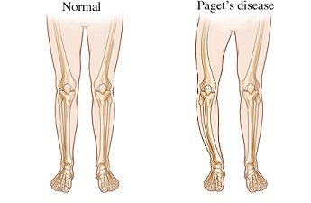 Orthopaedic and Joint Replacement Surgeon Dr. Deepak Raina Holds Good Experience with the Treatment of Paget’s Disease