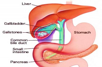 Cálculos biliares - sintomas, prevenção e remoção da vesícula biliar pela Dra. Prasanna Kumar Reddy, gastroenterologista cirúrgica, MBBS, FRCS